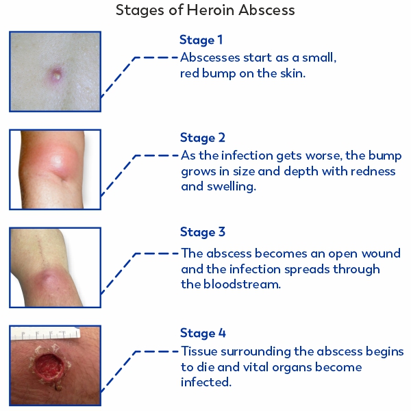 Stages-of-Heroin-Abcesses.jpg